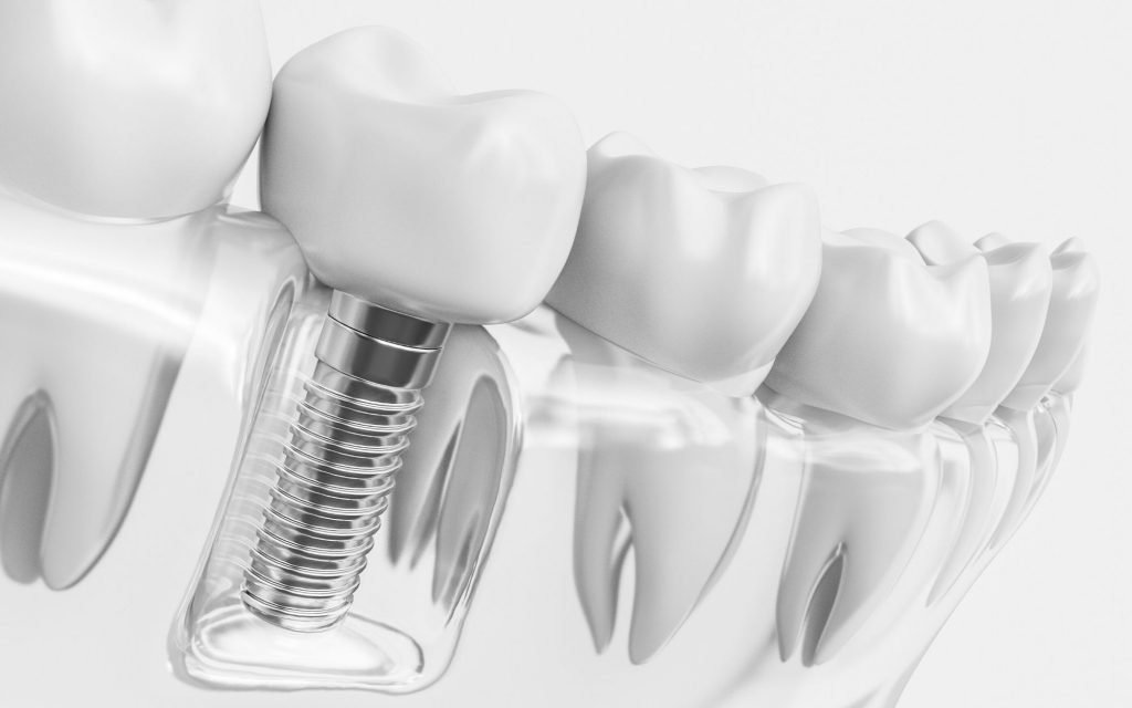 Crafting a Timeless Smile: The Role of Personalised Dental Implants