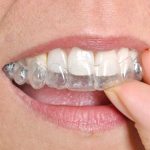 Innovative Invisalign Methods for Seamless Smile Enhancement