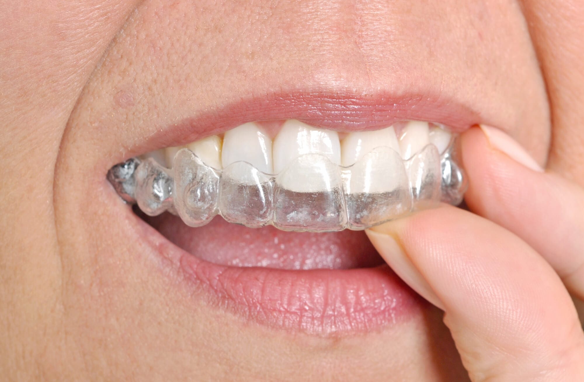 Innovative Invisalign Methods for Seamless Smile Enhancement