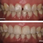 Innovative Smile Design: The Unseen Role of Composite Bonding