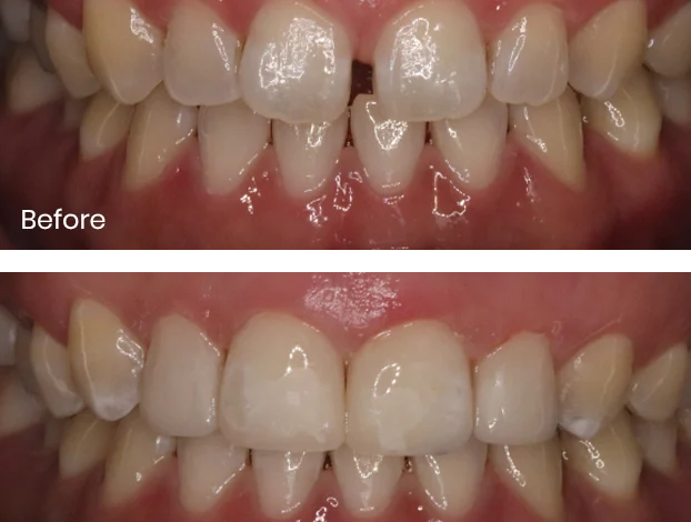Innovative Smile Design: The Unseen Role of Composite Bonding