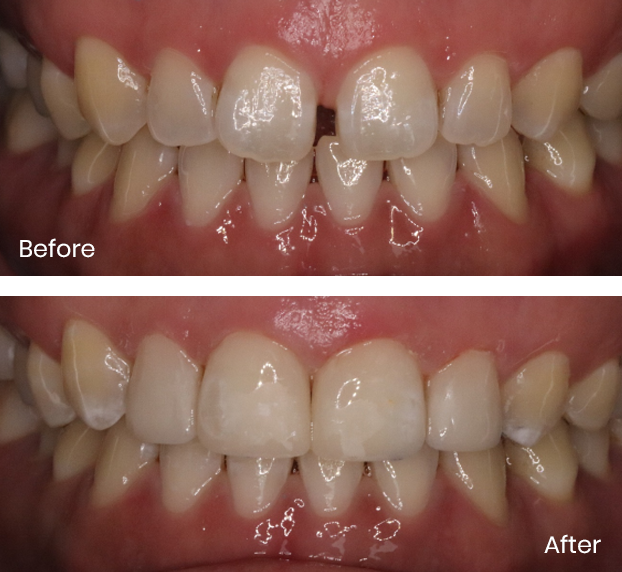 Innovative Smile Design: The Unseen Role of Composite Bonding