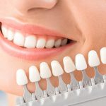 Veneers: The Intersection of Comfort and Style in Dentistry