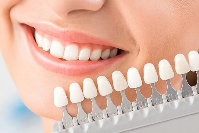 Veneers: The Intersection of Comfort and Style in Dentistry