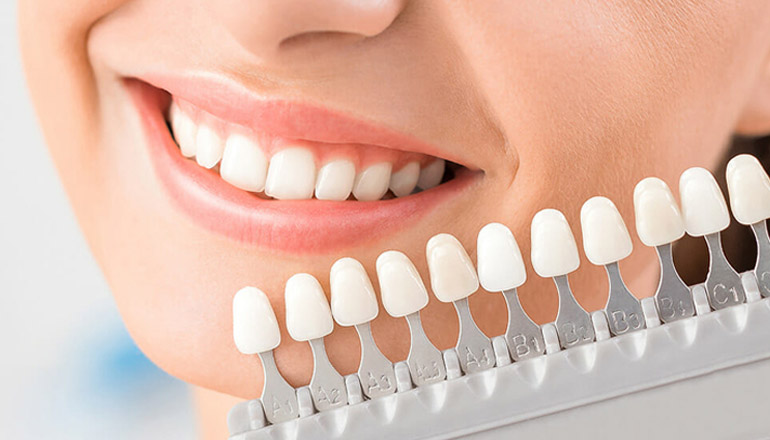 Veneers: The Intersection of Comfort and Style in Dentistry