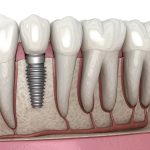 Exploring the Impact of Stress on Dental Implant Success