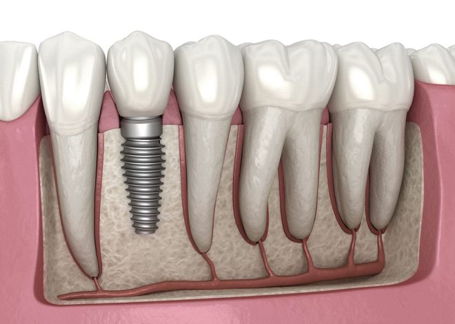 Exploring the Impact of Stress on Dental Implant Success