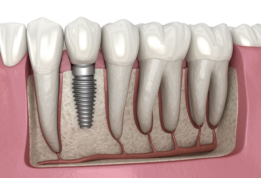 Exploring the Impact of Stress on Dental Implant Success